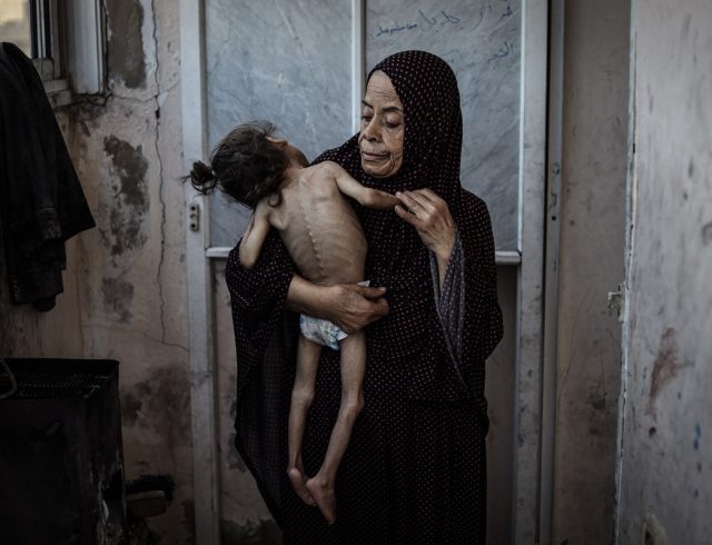 Malnutrition threatens life of 6-year-old girl in Gaza