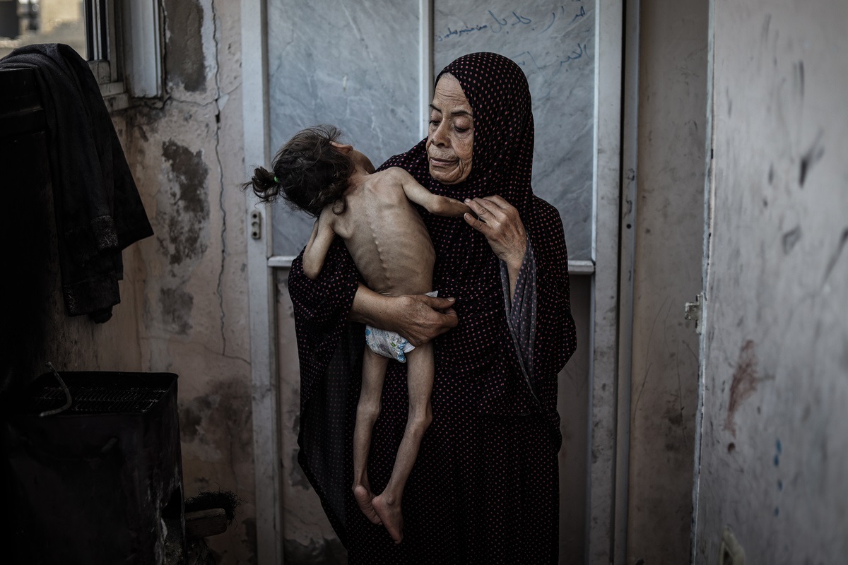 Malnutrition threatens life of 6-year-old girl in Gaza