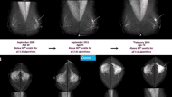 μαστογραφια